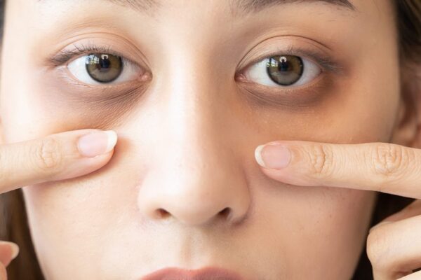 What treatment is best for dark circles