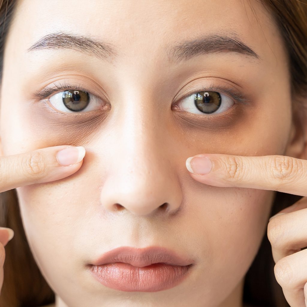 What treatment is best for dark circles