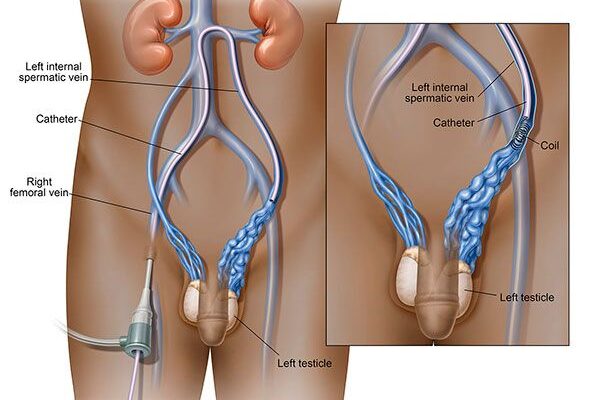 varicocele treatments