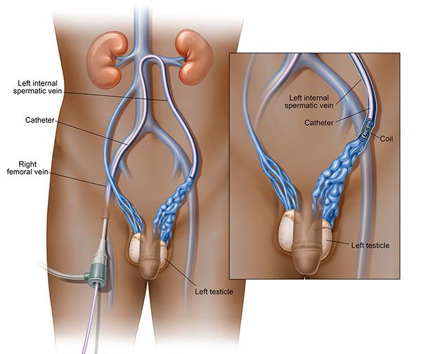 varicocele treatments