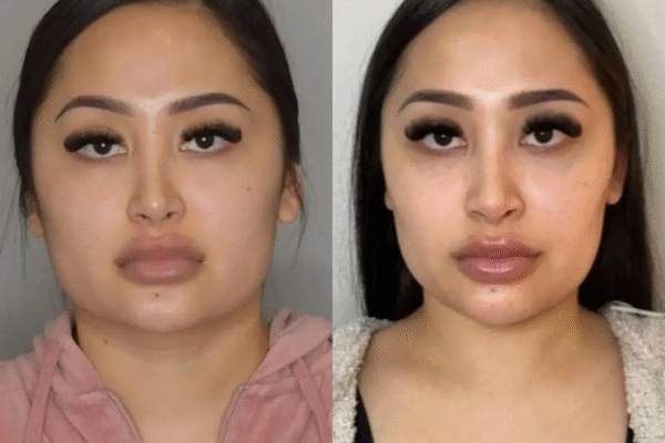 How Buccal Fat Removal in Dubai Boosts Self-Confidence Buccal Fat Removal