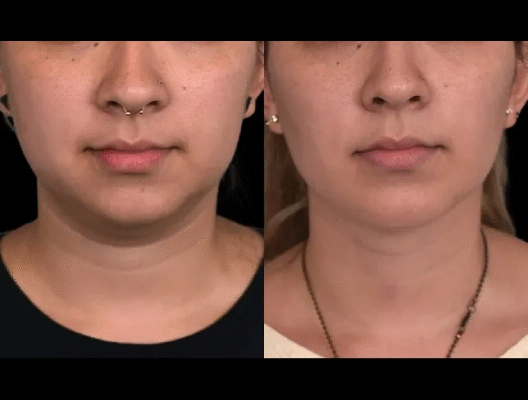 Double chin removal in Dubai: Fixing face symmetry Double chin removal