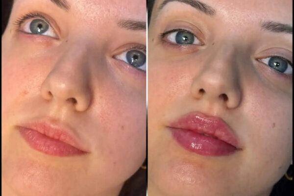 FILLERS-IN-DUBAI