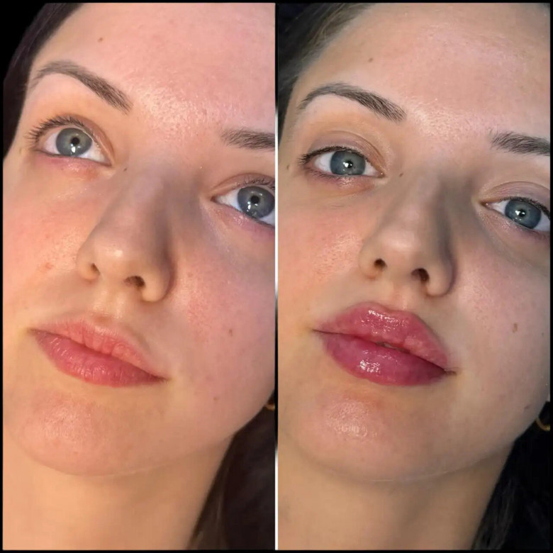 FILLERS-IN-DUBAI