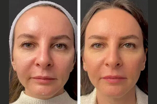 Celebrity-Recommended Best Doctors in Dubai for Mesotherapy