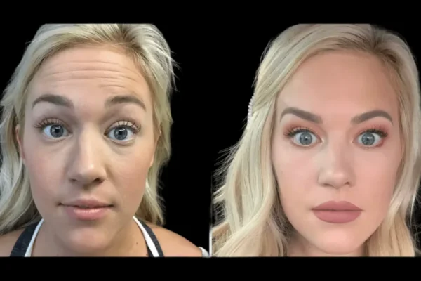 botox in dubai