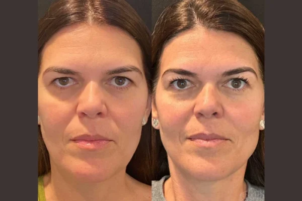Common Questions Answered by the Best Plastic Surgeons in Dubai About Thread Lifts