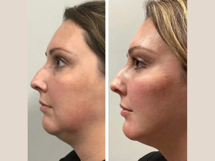 PRP Treatmnt