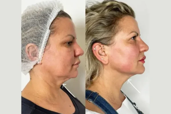 Endolift in Dubai: The Future of Skin Tightening Without Surgery