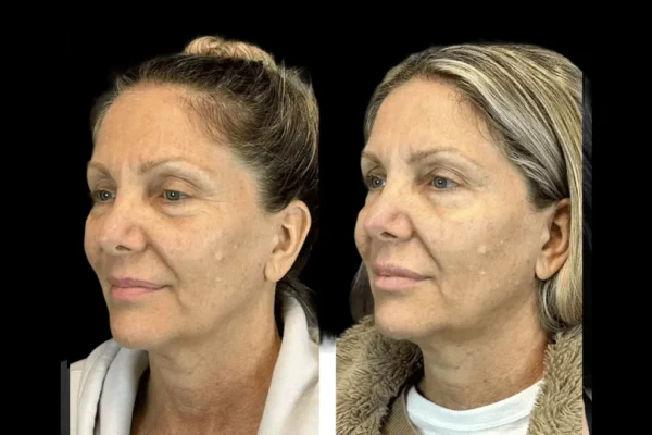 Botox for Migraines: Insights from the Best Doctors in dubai