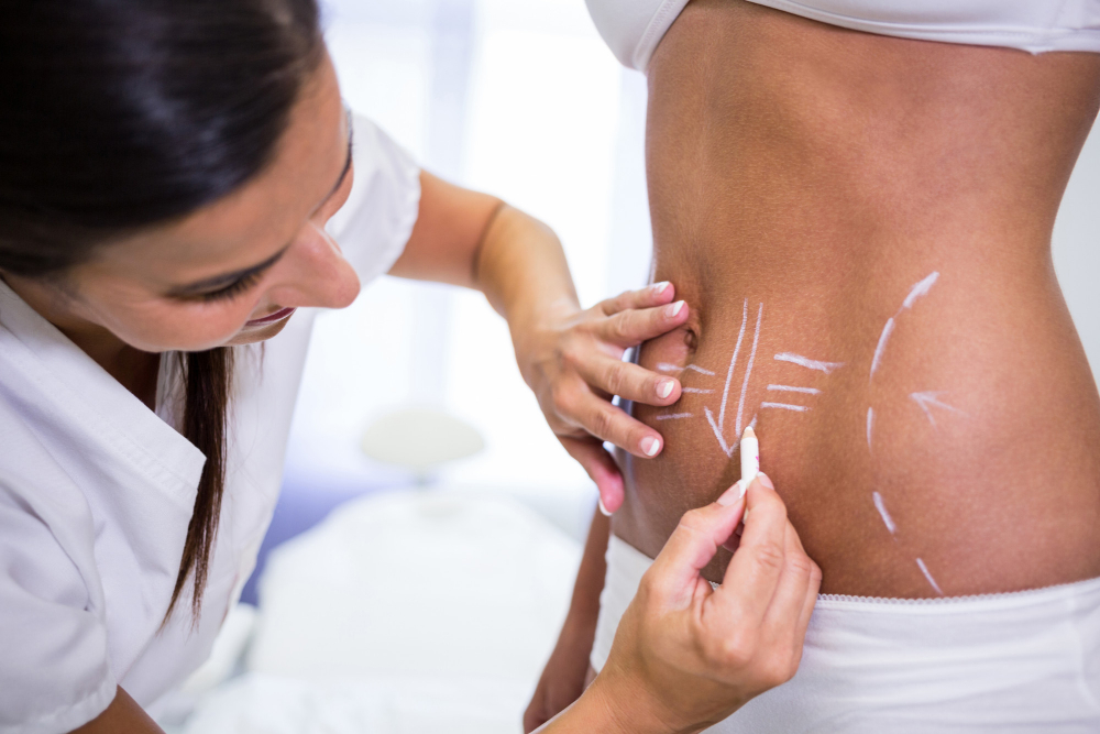 Tummy Tuck in Dubai